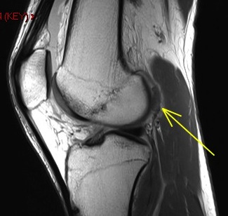 Figure 3 for case Osteochondral fracture femur with displaced fragment